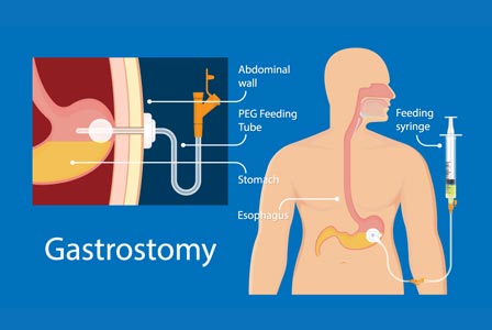 elevate-gastroenterology-gastrostomy-tube